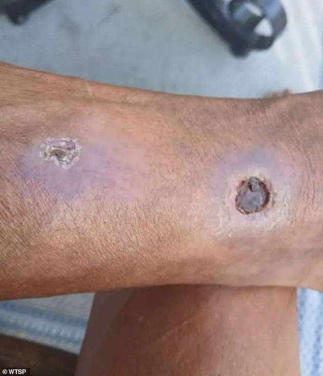 Late-Breaking Lawsuit: Florida Woman Sues Apartment Complex Over Spider Infestation That Led to Amputation, Citing Negligence