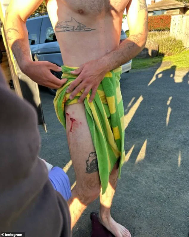 California Surfer Injured in Harrowing 6ft Shark Attack Near Gualala, 115 Miles North of San Francisco