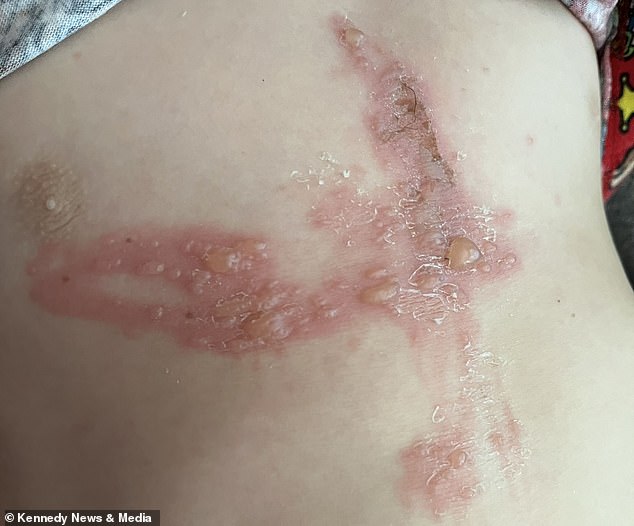 Six-year-old boy suffers severe burns after playing with giant hogweed.