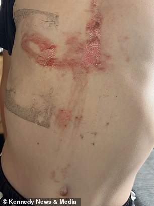Six-year-old boy suffers severe burns after playing with giant hogweed.