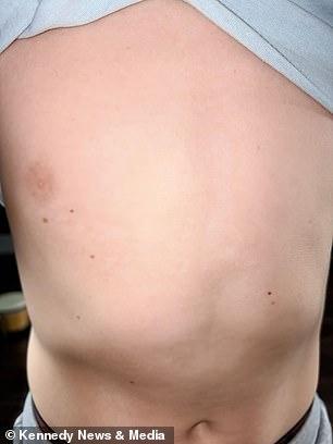 Six-year-old boy suffers severe burns after playing with giant hogweed.