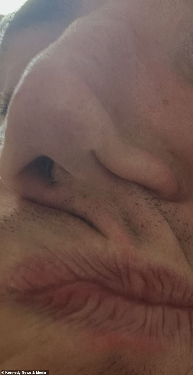 Bradley Robinson shares how cocaine addiction cost him his nose and £35,000.